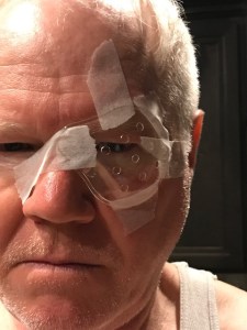 Postoperative cataract cyclops.  Here I am wearing an eye guard. You're not supposed to rub your eyes for a few weeks after cataract surgery. This getup prevents nighttime eye rubbing.
